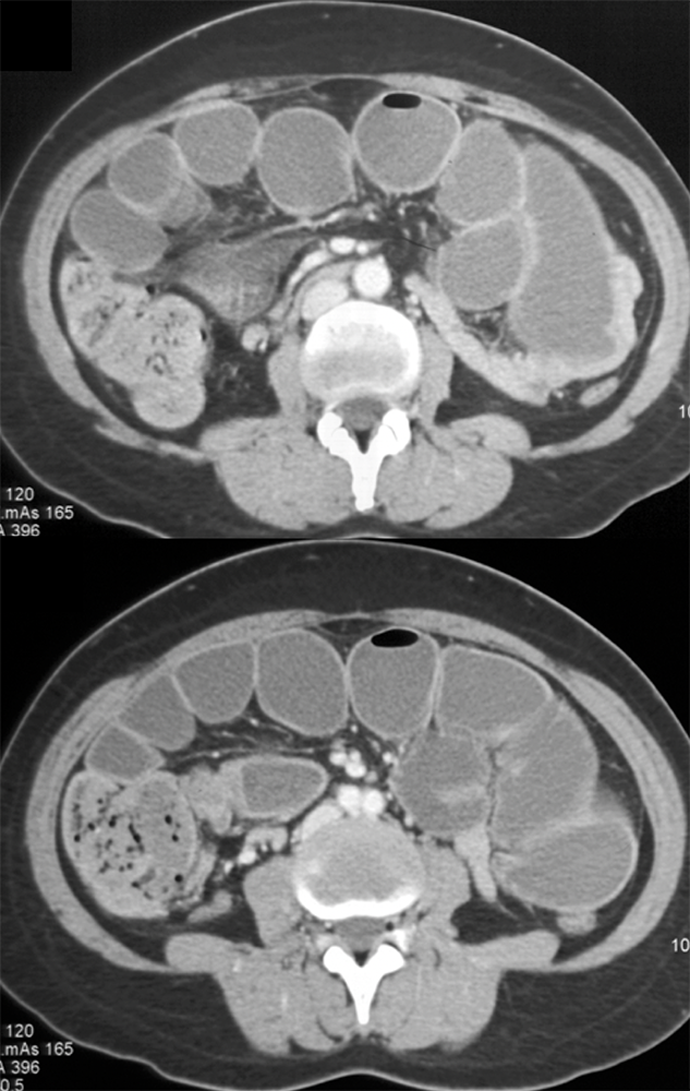 Endometriosis