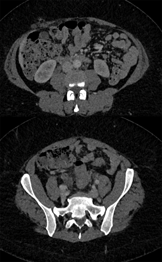 Endometriosis