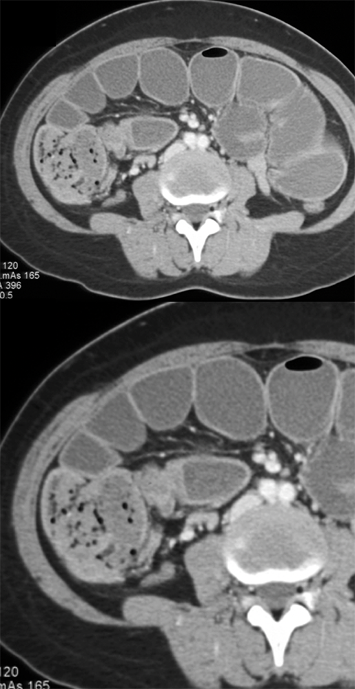 Endometriosis