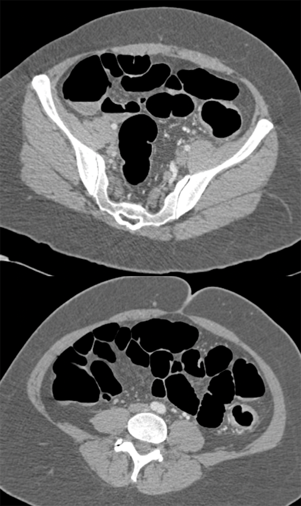 Endometriosis Simulates Infiltrating Carcinoma