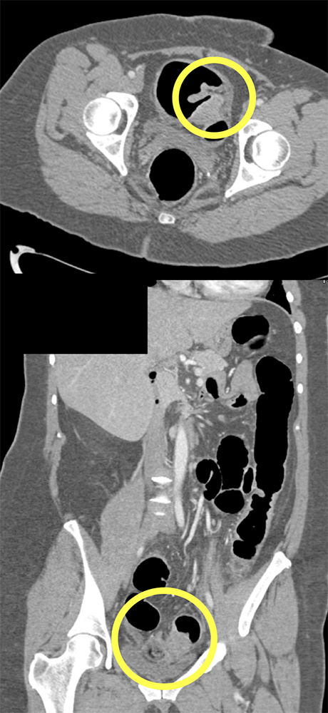 Endometriosis Simulates Infiltrating Carcinoma