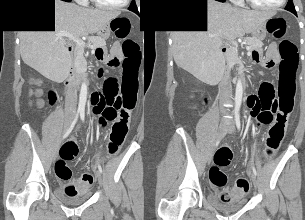 Endometriosis Simulates Infiltrating Carcinoma