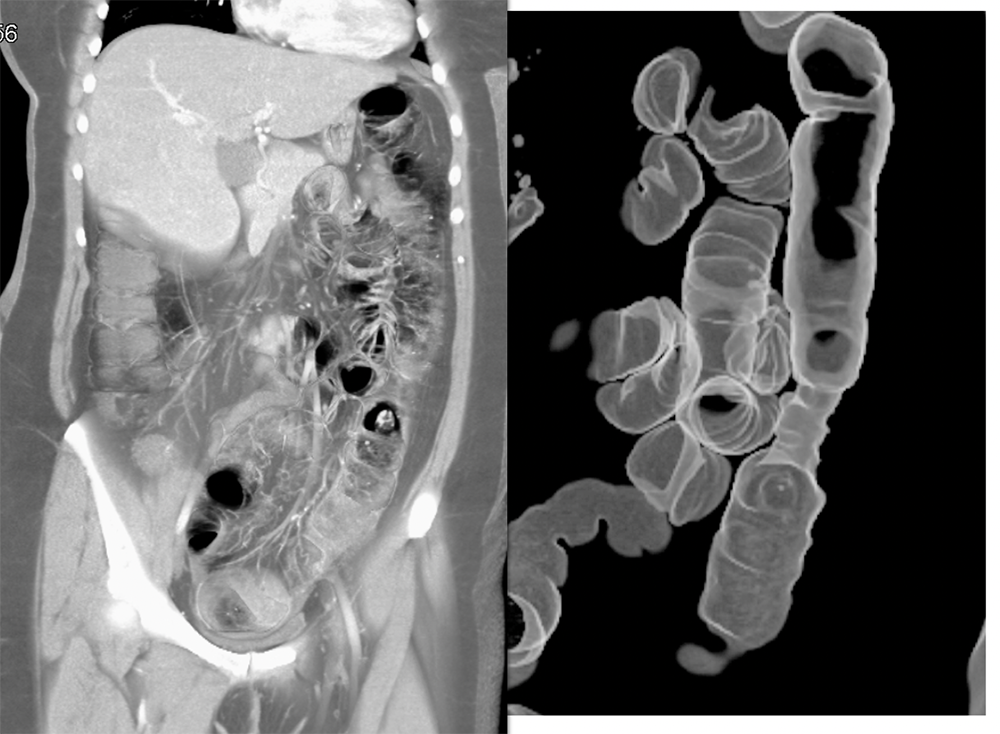 Endometriosis Simulates Infiltrating Carcinoma