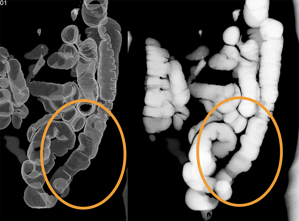 Endometriosis Simulates Infiltrating Carcinoma