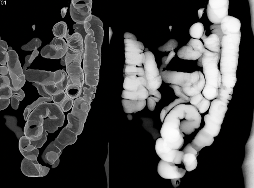 Endometriosis Simulates Infiltrating Carcinoma