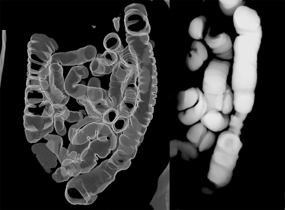 Endometriosis Simulates Infiltrating Carcinoma