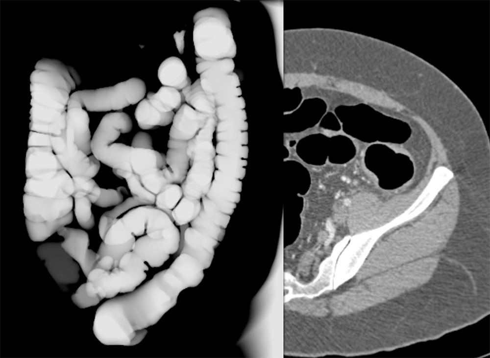 Endometriosis Simulates Infiltrating Carcinoma