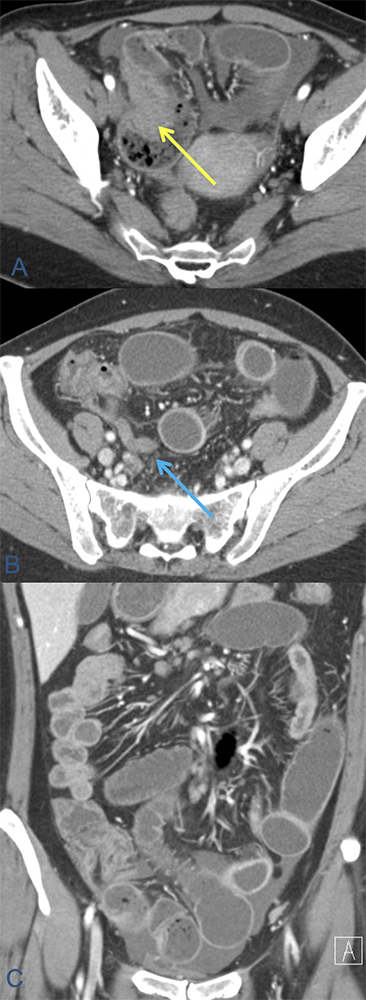 Small bowel endometriosis causing obstruction