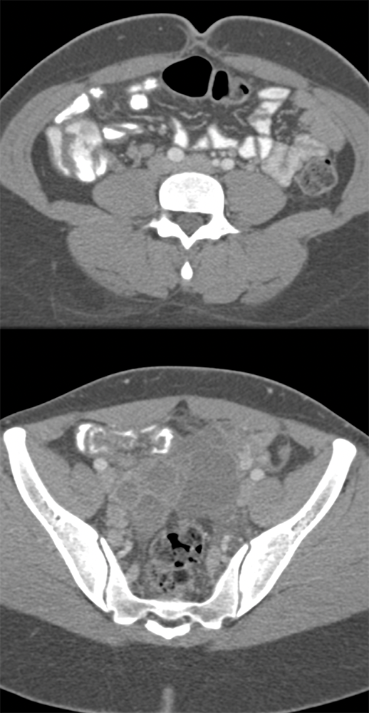 Endometriosis