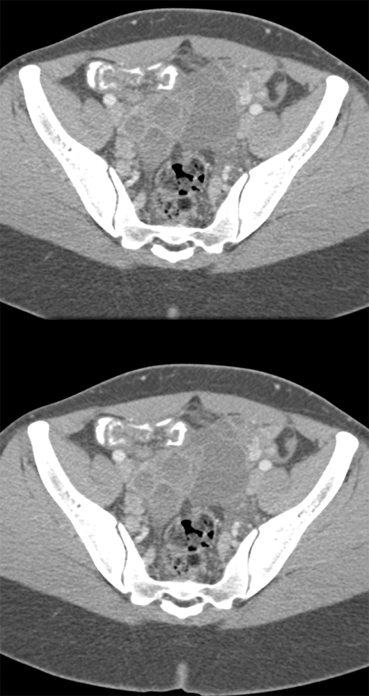 Endometriosis