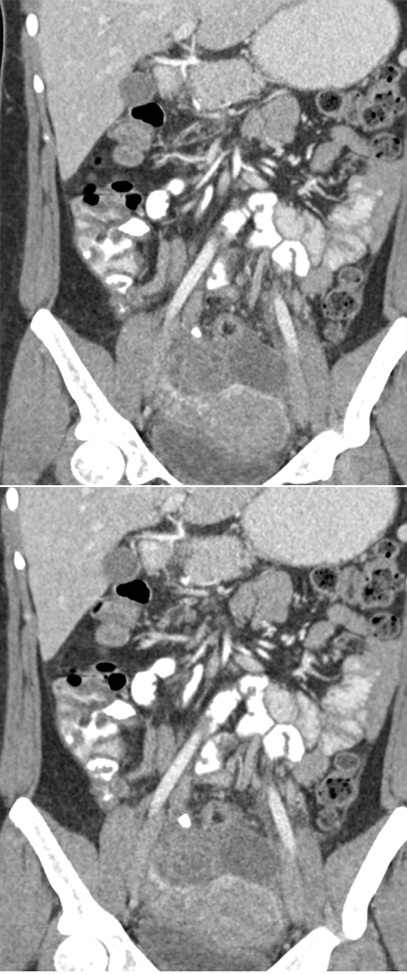 Endometriosis