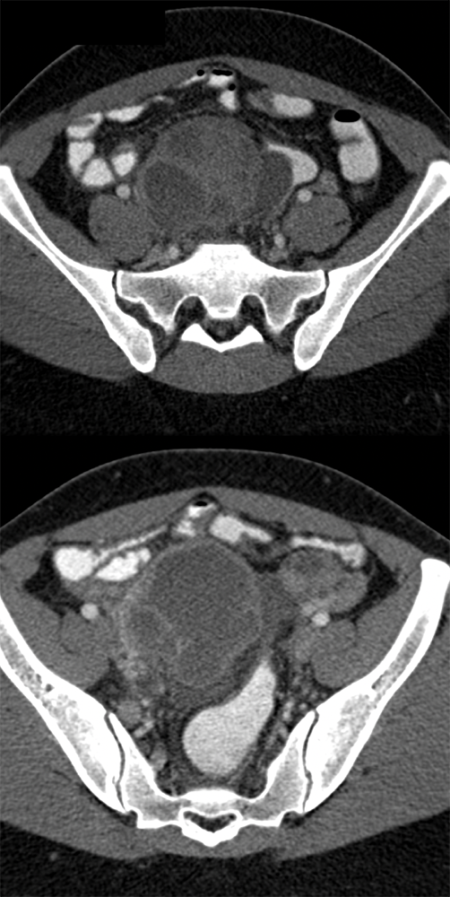 Endometriosis