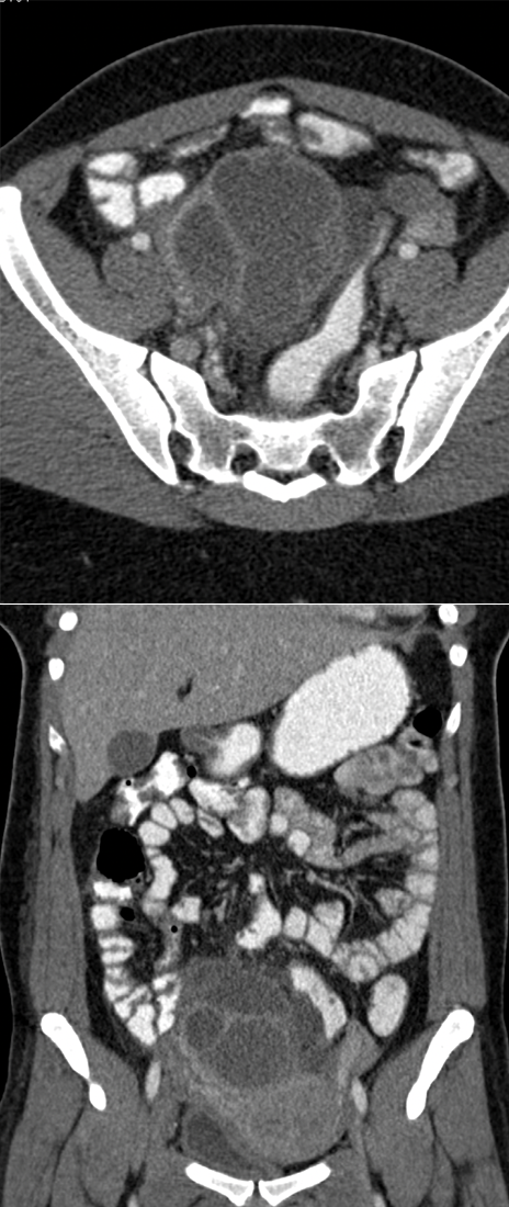 Endometriosis