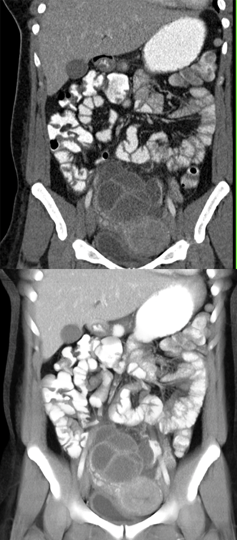 Endometriosis