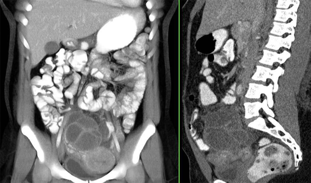 Endometriosis