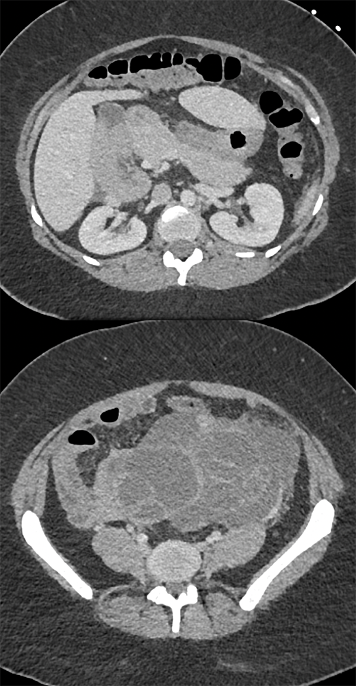 Endometriosis