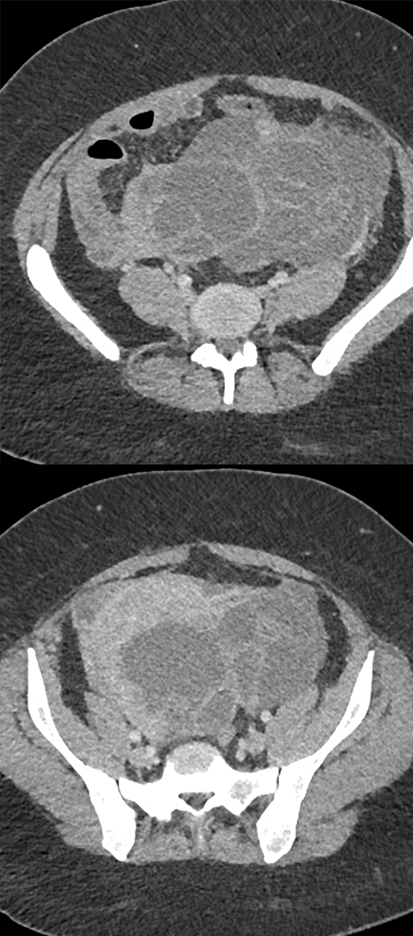 Endometriosis