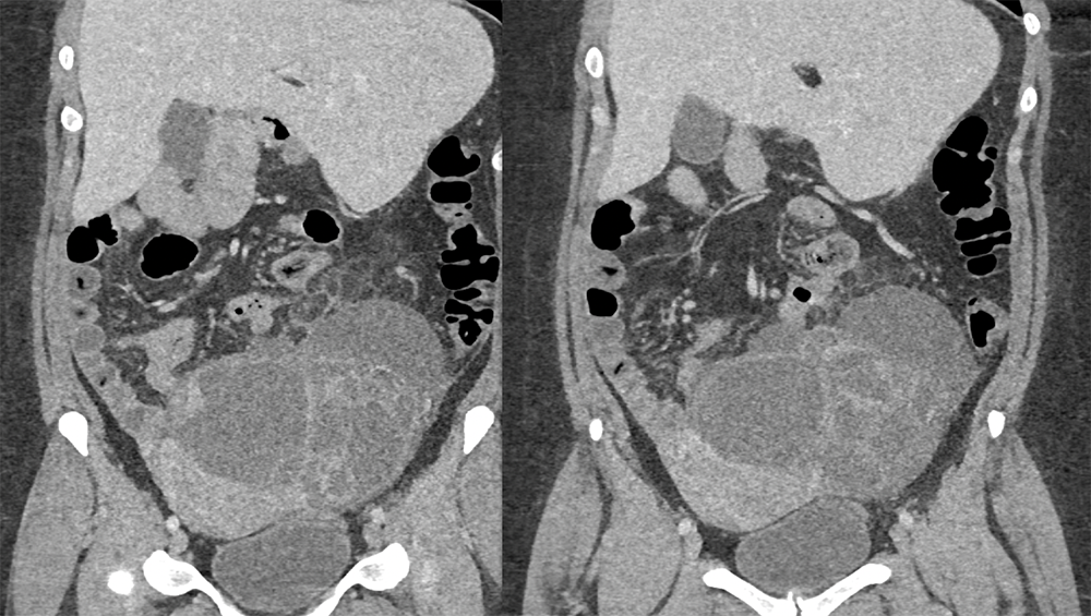 Endometriosis