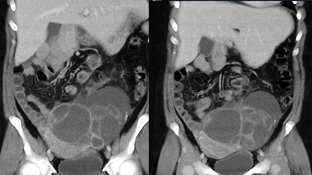 Endometriosis