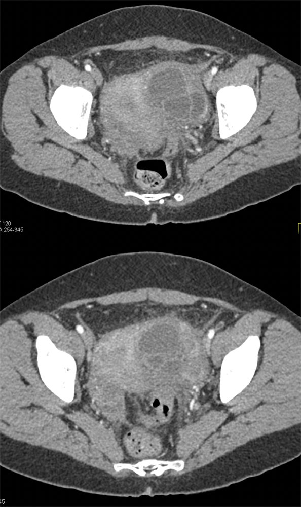 Endometriosis