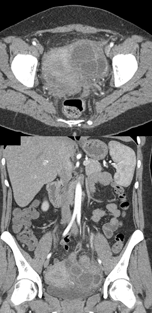 Endometriosis