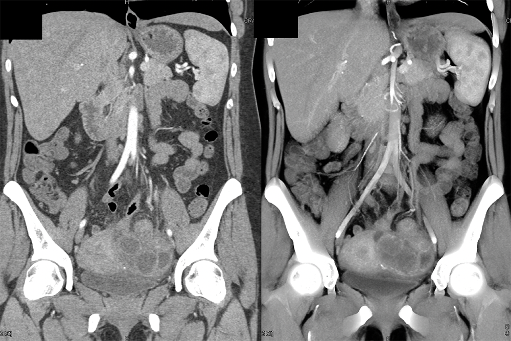 Endometriosis