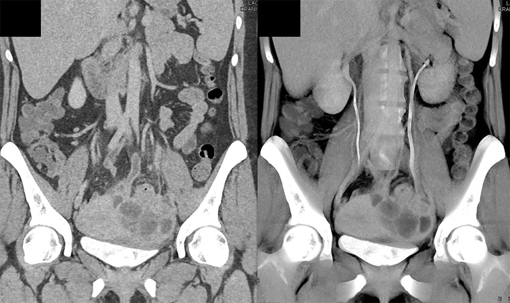 Endometriosis