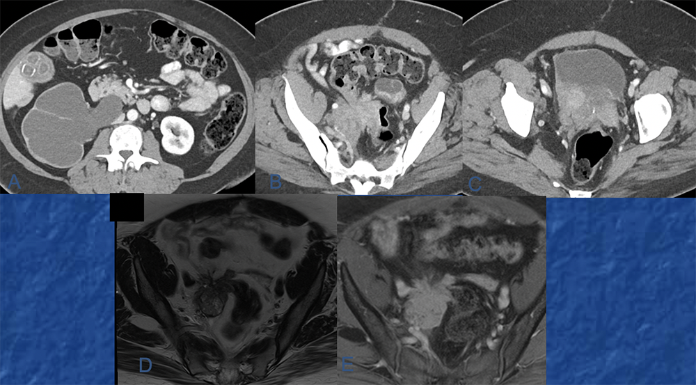 Endometriosis of the distal ureter and bladder