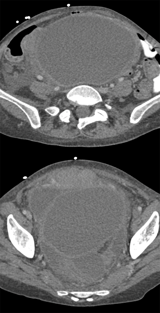 Endometriosis