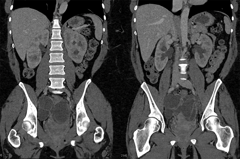 Endometriosis