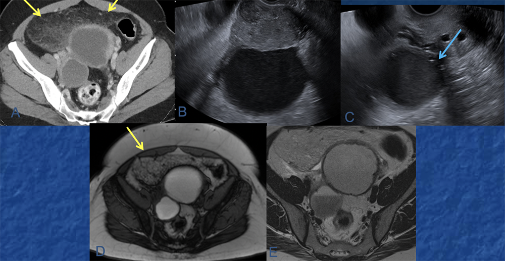 Ruptured endometrioma