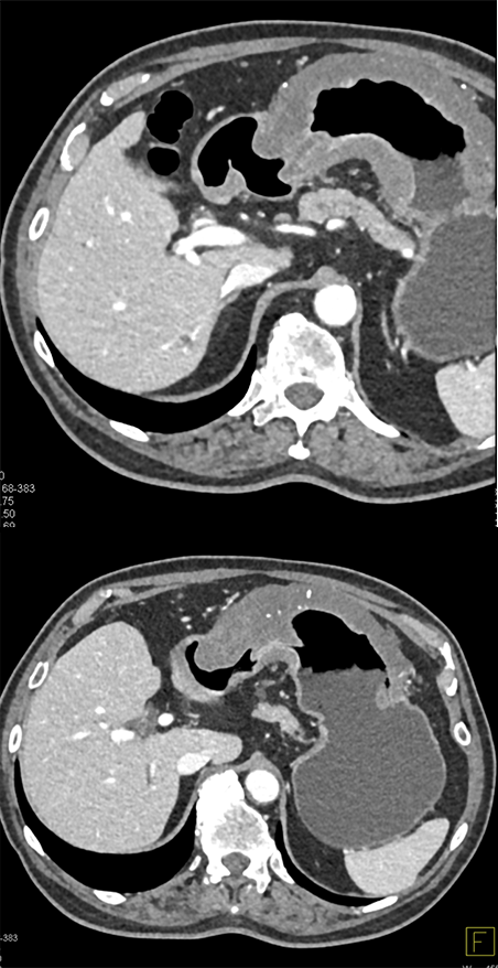 Gastric Adenocarcinoma in an ER Patient 