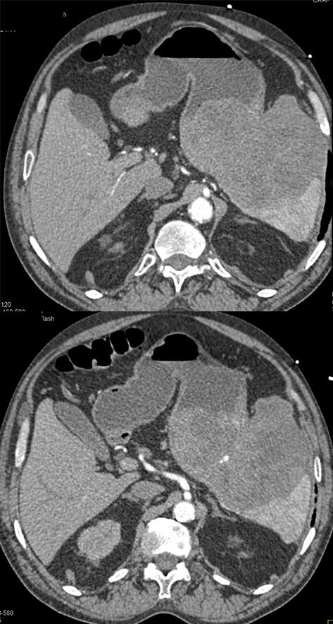 Gastric GIST Tumor