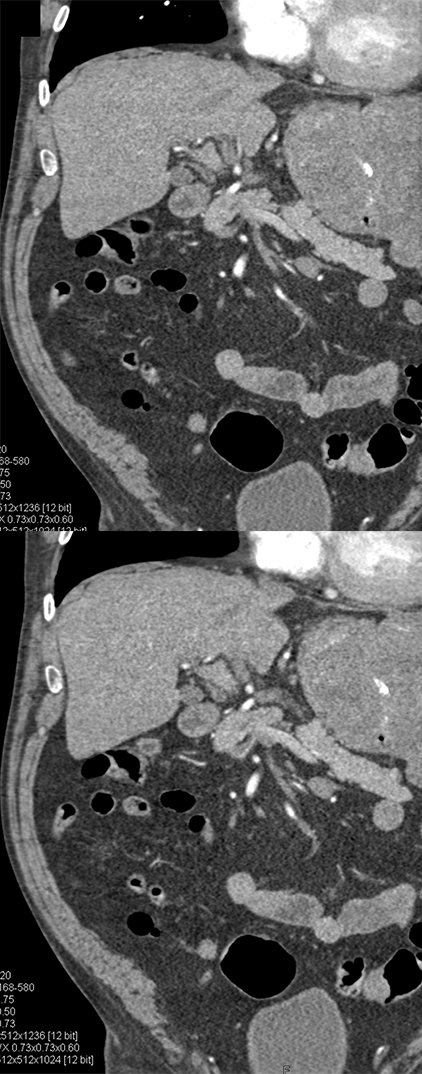 Gastric GIST Tumor