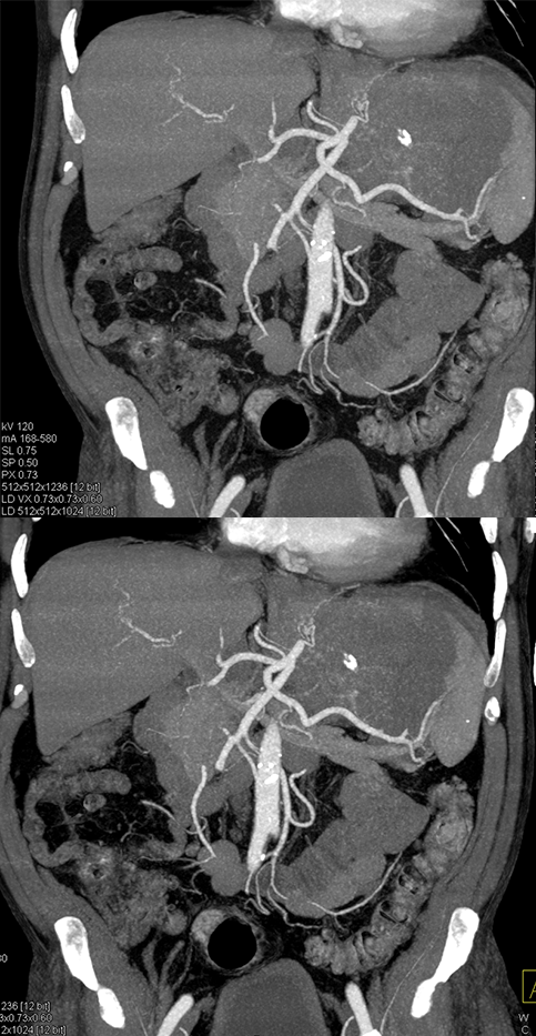 Gastric GIST Tumor