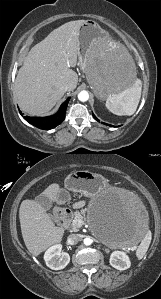 Gastric GIST