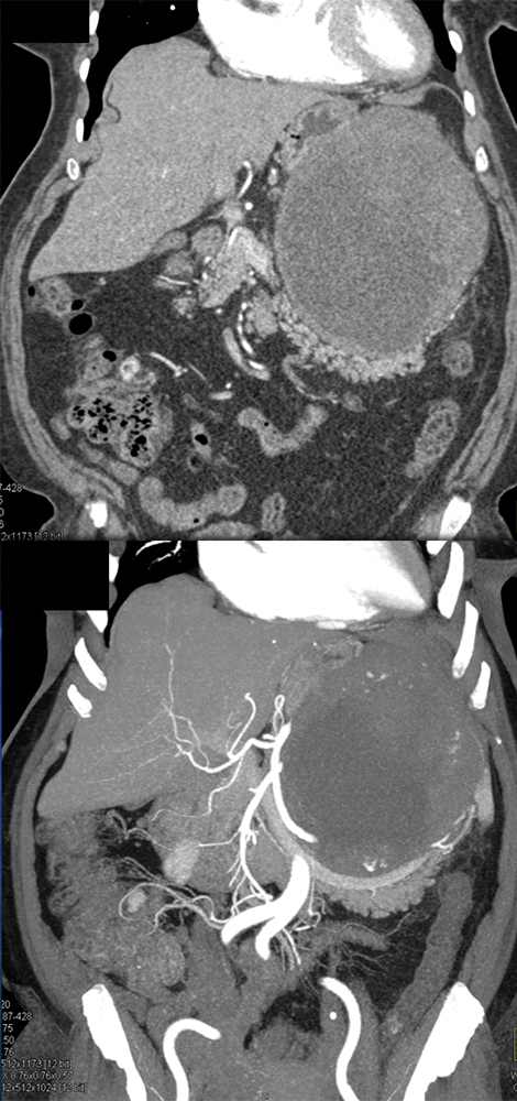 Gastric GIST