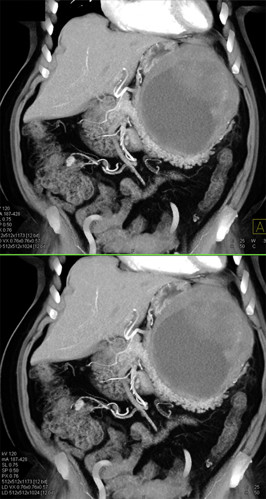 Gastric GIST