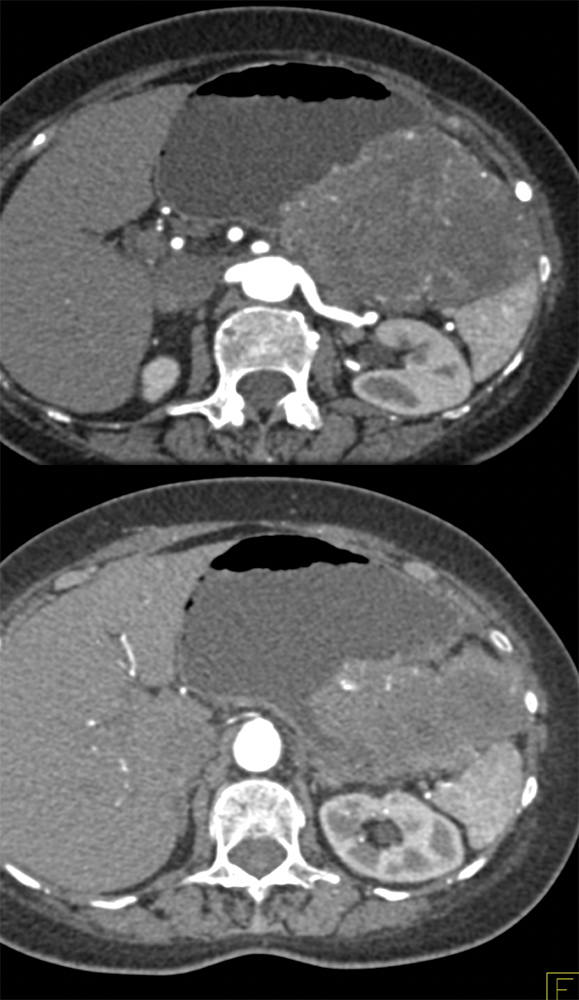 GIST Tumor Presents as GI Bleed