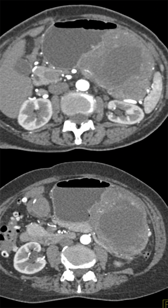 GIST Tumor Presents as GI Bleed