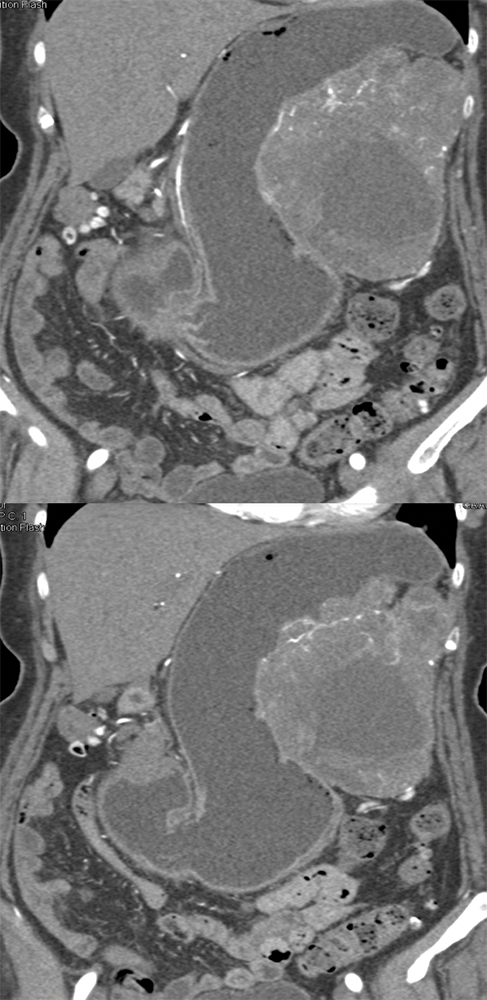 GIST Tumor Presents as GI Bleed