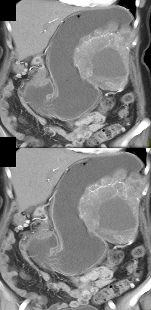 GIST Tumor Presents as GI Bleed