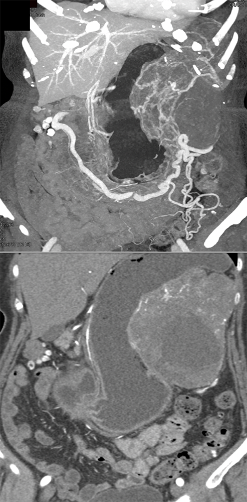 GIST Tumor Presents as GI Bleed