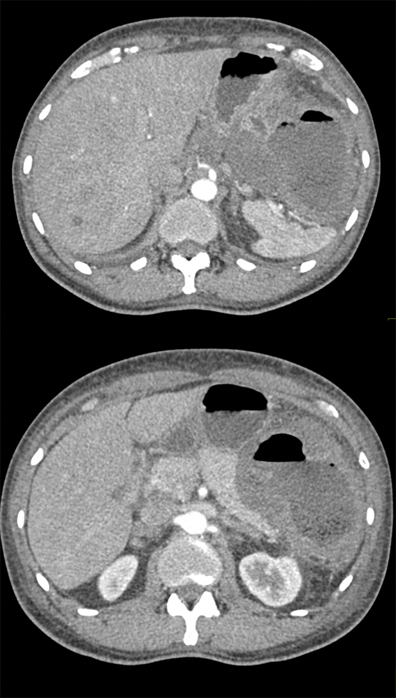 Necrotic Gastric GIST Tumor