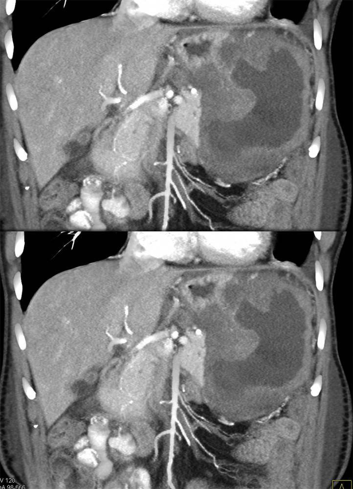 Necrotic Gastric GIST Tumor