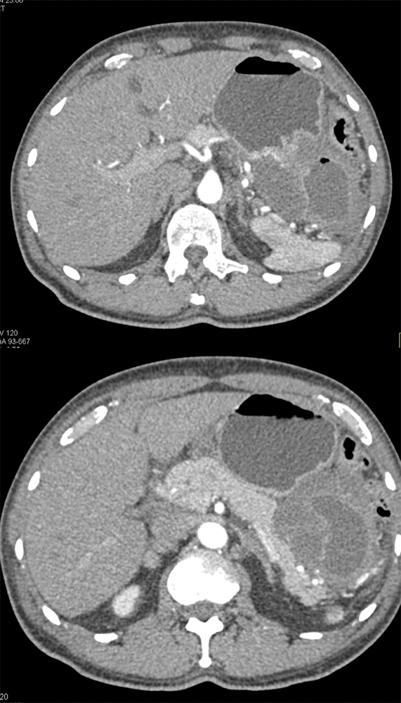 Ulcerating Gastric GIST Tumor