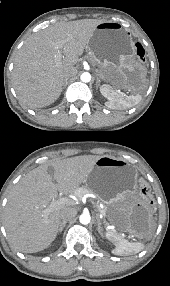 Ulcerating Gastric GIST Tumor