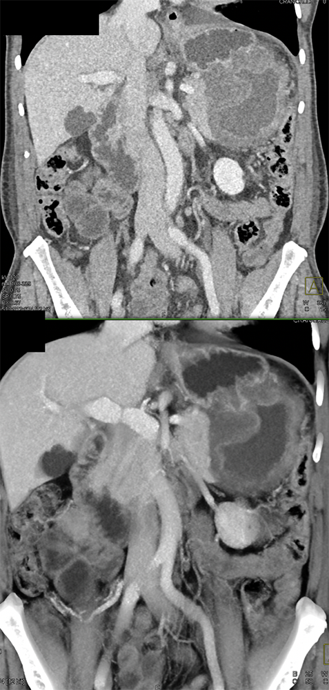 Ulcerating Gastric GIST Tumor