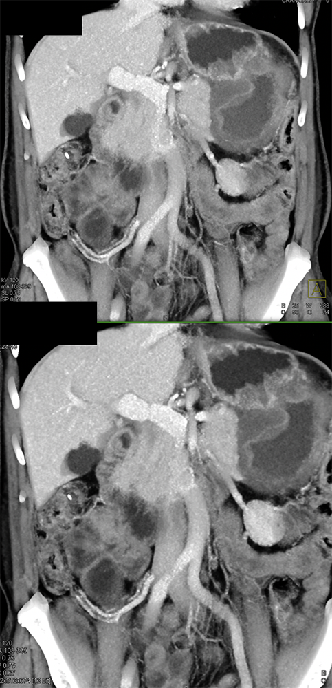 Ulcerating Gastric GIST Tumor