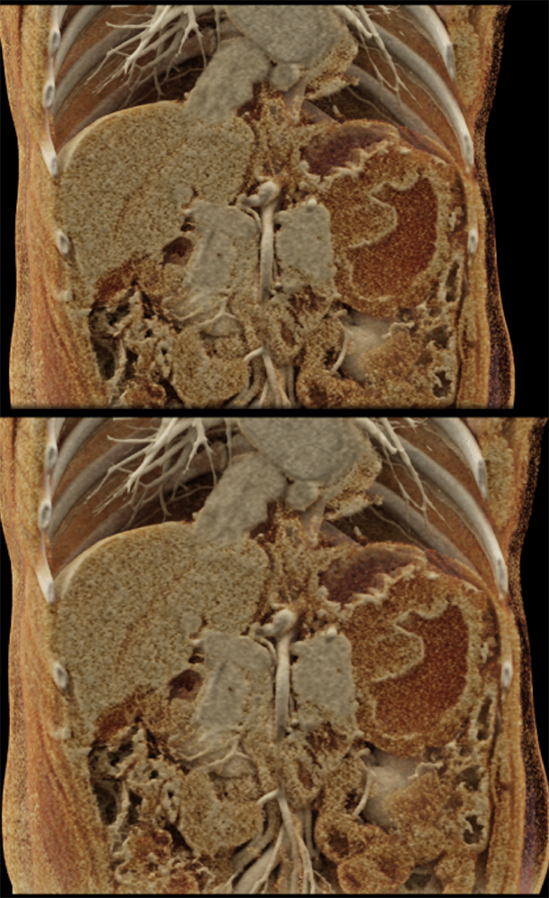 Ulcerating Gastric GIST Tumor